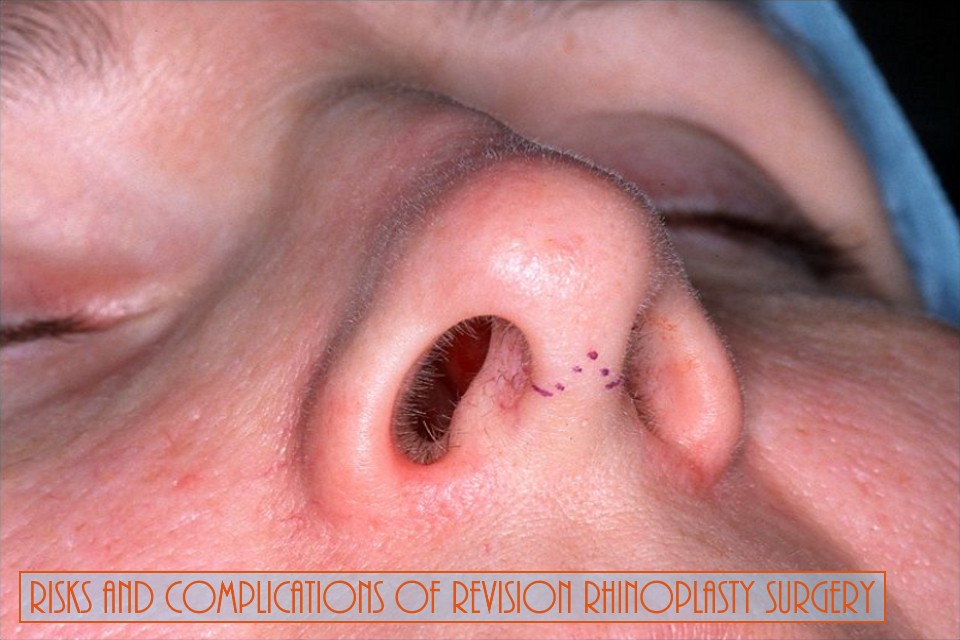 Risks And Complications Of Revision Rhinoplasty Surgery